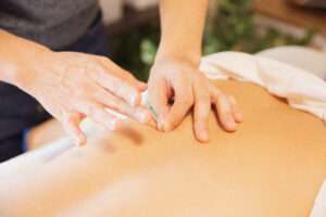 acupuncture. tips for back pain